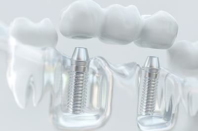 model showing attaching an implant bridge