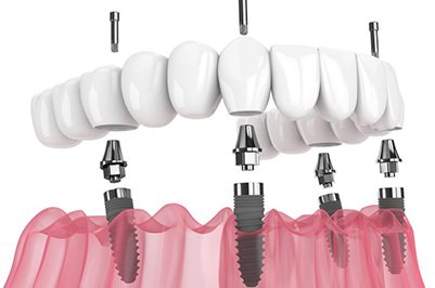 a 3D illustration of All-On-4 dental implants