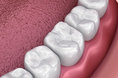 Animated smile with dental sealants