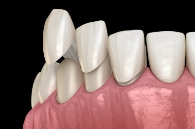 Animated smile during porcelain veneer placement