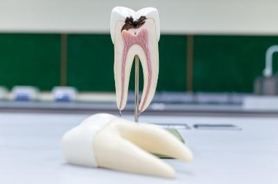 Model tooth demonstrating need for root canal therapy