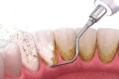 Animated smile during scaling and root planing