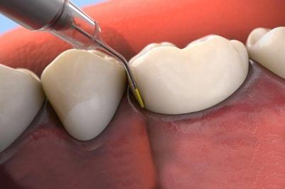 Animated smile during Arestin antibiotic therapy