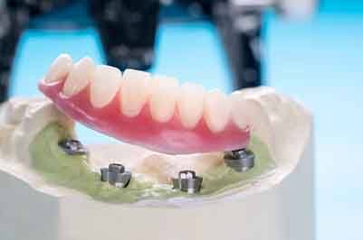 A denture lifted slightly above a model to reveal dental implants underneath