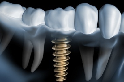 Animated smile with dental implant supported replacement tooth