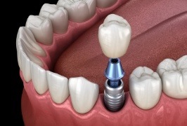 Animated smile with dental implant supported dental crown