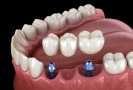 Animated mile with dental implant supported fixed bridge