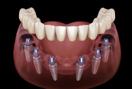 Animated smile with dental implant supported denture
