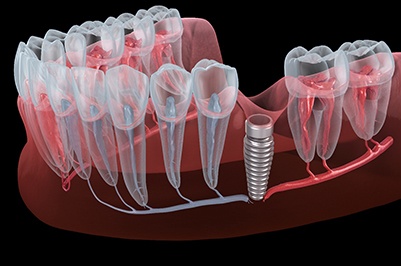 Failed dental implant