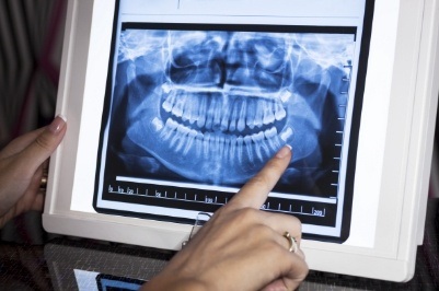 Dentist pointing to digital x-ray