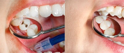 metal fillings vs tooth-colored fillings in Putnam