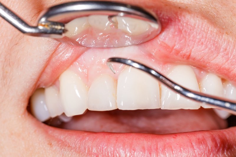 person having gums checked by dentist