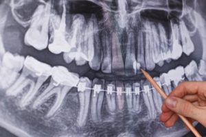 Dentist using a pencil to point out a cavity between two teeth on a dental X-ray