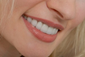 Porcelain veneers