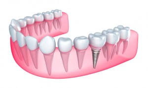 ThinkstockPhotos-177232118, dental implants