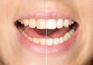 Your Putnam dentist discusses the benefits of professional teeth whitening vs over the counter.